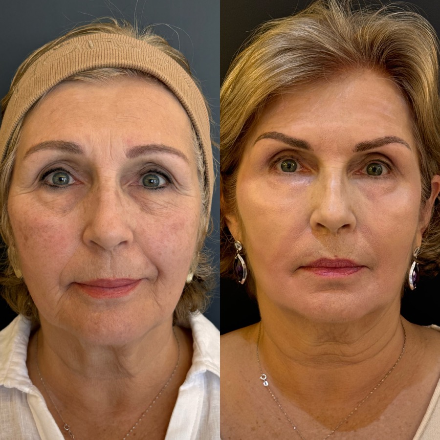 Resultado antes e depois LineSkin