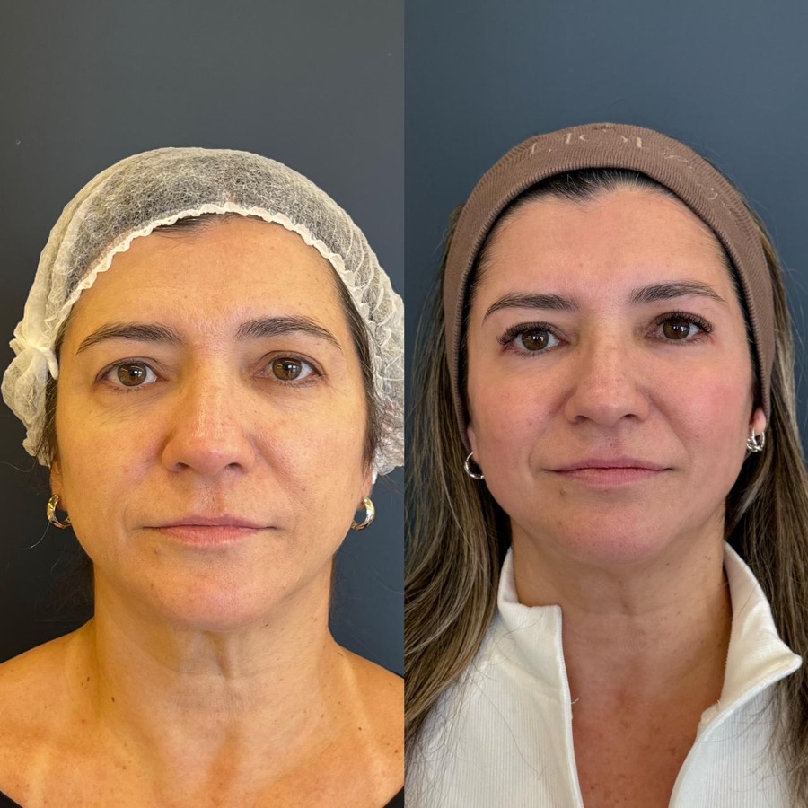 Resultado antes e depois LineSkin