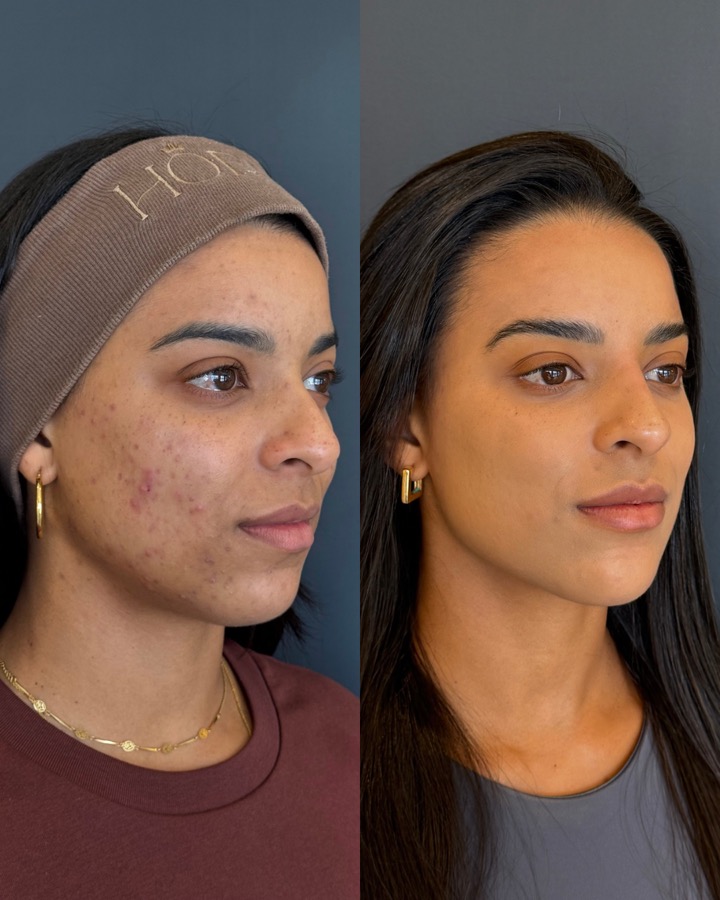 Resultado antes e depois LineSkin