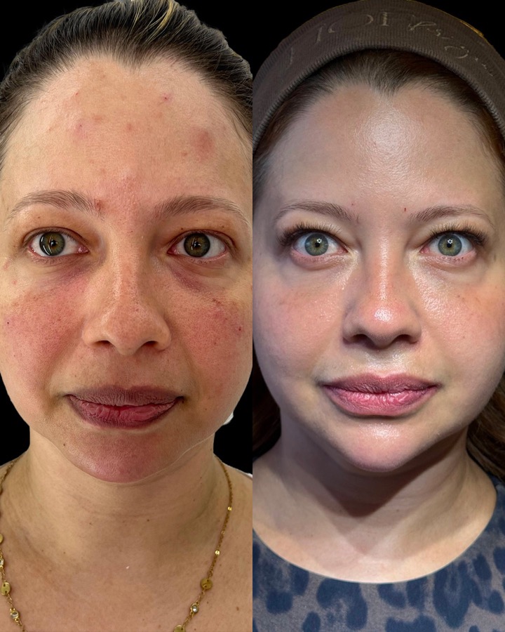 Resultado antes e depois LineSkin