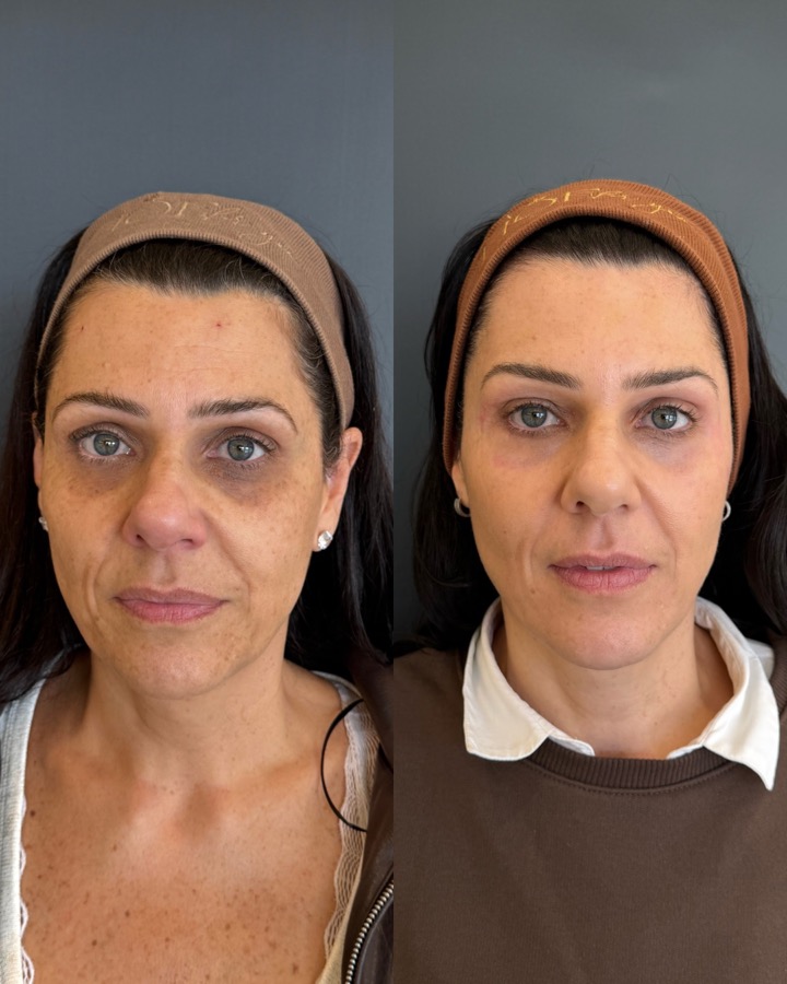 Resultado antes e depois LineSkin